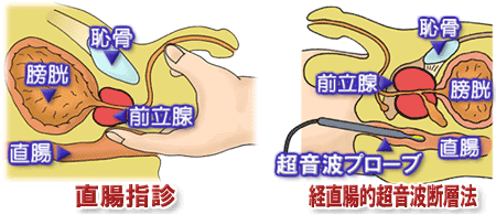 直腸指診、経直腸的超音波断層法